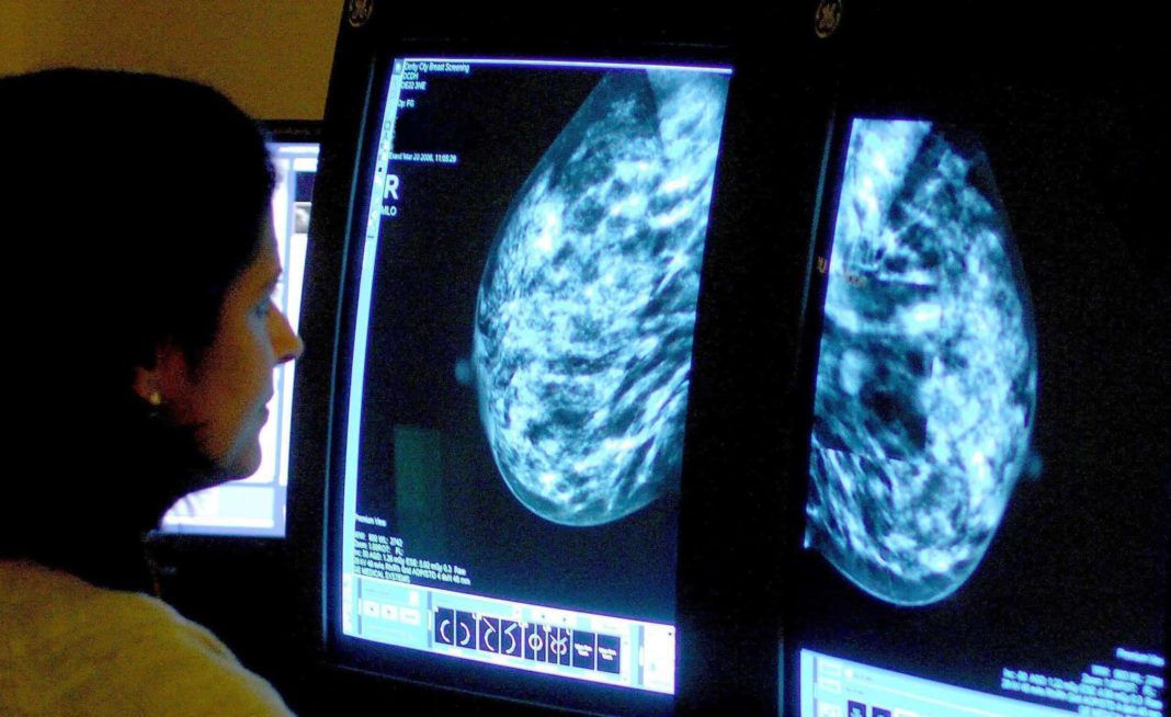 One million breast screenings missed because of pandemic